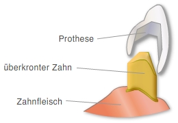 Teleskopprothese