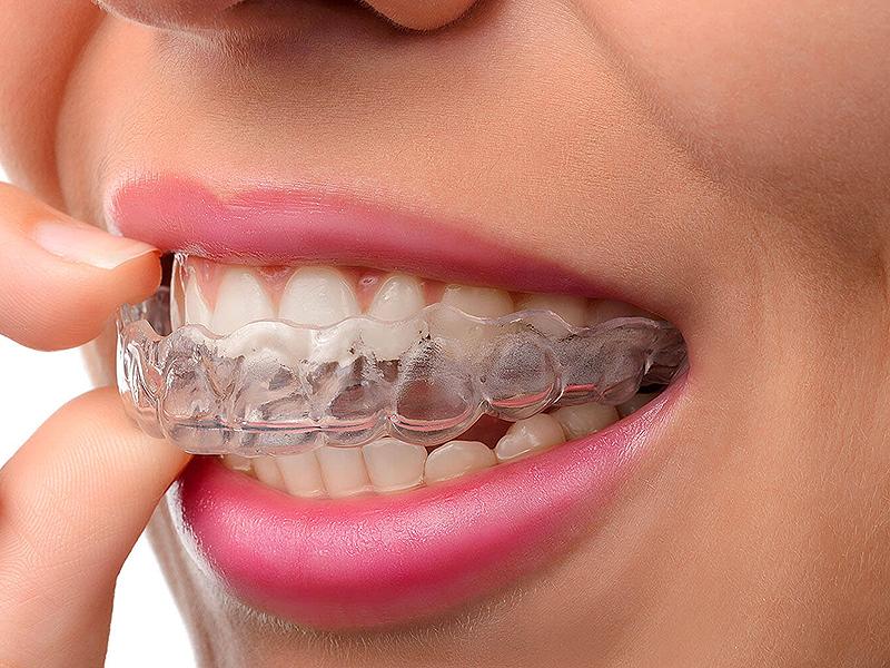 Transparente Zahnschienen mit Invisalign