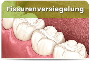 Fissurenversiegelung