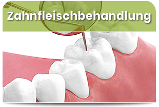 Zahnfleischbehandlung