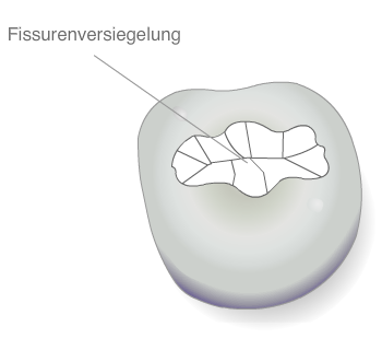 Fissurenverziegelung