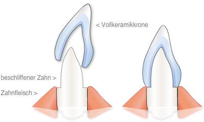 Vollkeramikkronen