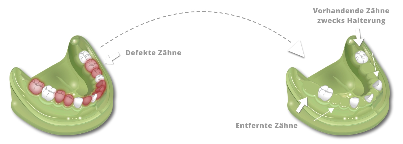 Ästhetischer Zahnersatz - Teleskope aus Vollkeramik