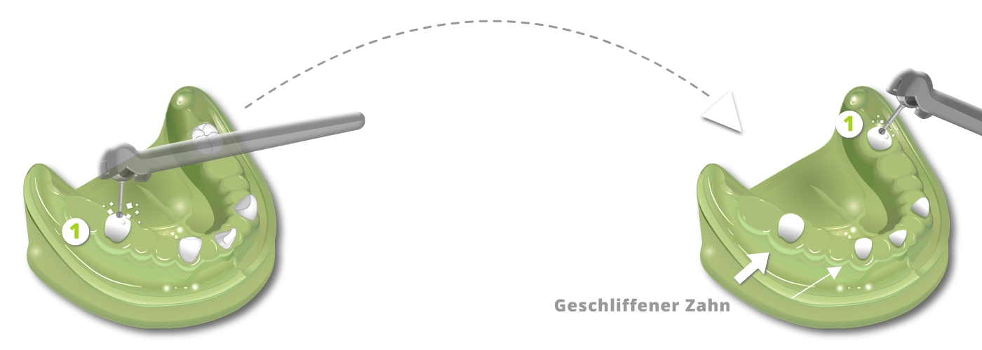 Ästhetischer Zahnersatz - Teleskope aus Vollkeramik