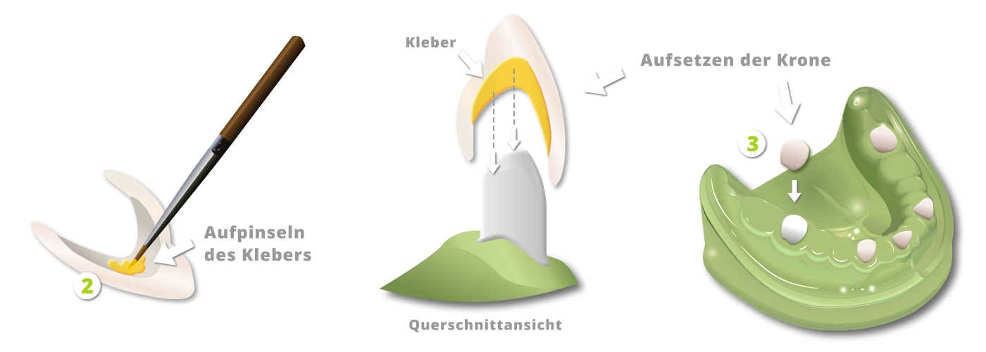 Ästhetischer Zahnersatz - Teleskope aus Vollkeramik