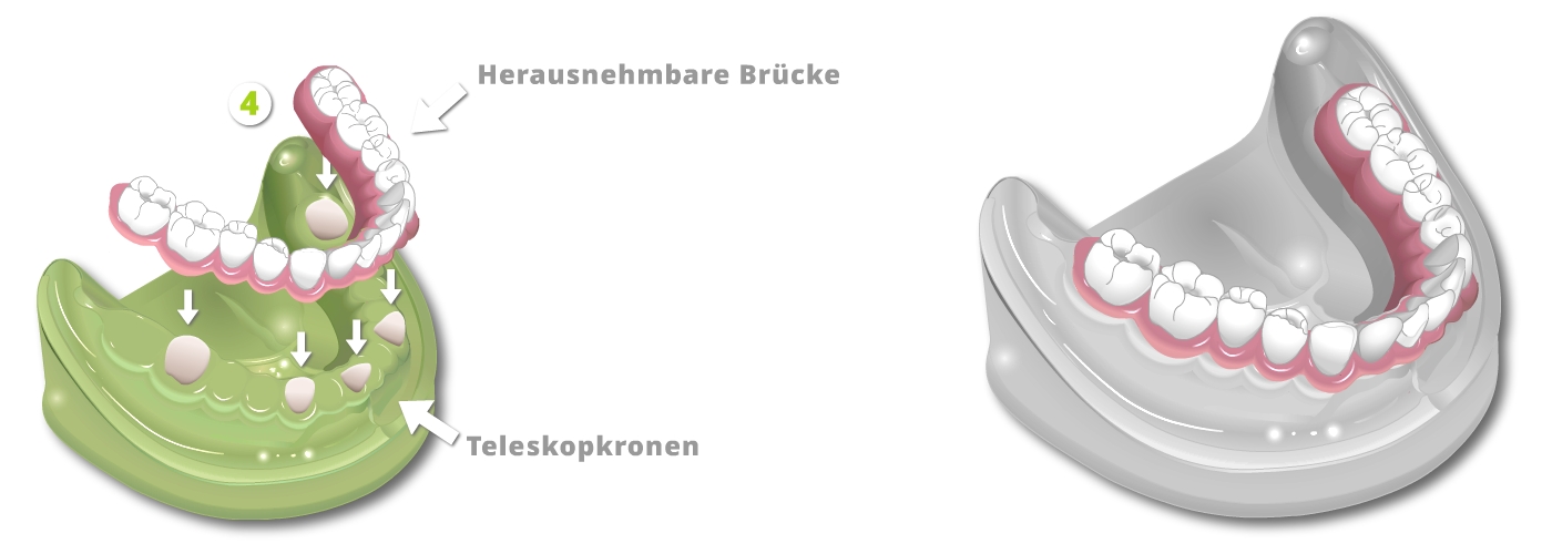 Ästhetischer Zahnersatz - Teleskope aus Vollkeramik